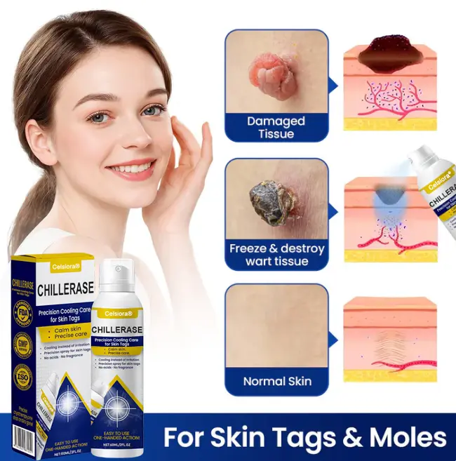 Celsiora® ChillErase Cooling Spray for Skin Tags