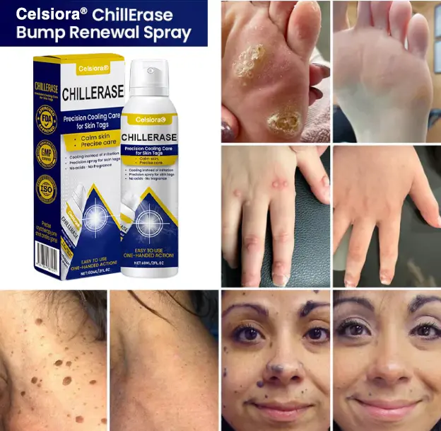 Celsiora® ChillErase Cooling Spray for Skin Tags