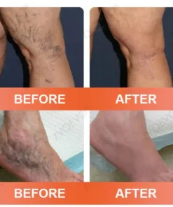 Celsiora® Vein Ease Microneedle Care Patch