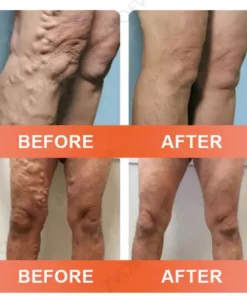 Celsiora® Vein Ease Microneedle Care Patch