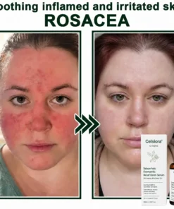 Celsiora® Seborrheic Dermatitis Relief Derm Serum
