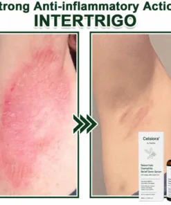Celsiora® Seborrheic Dermatitis Relief Derm Serum