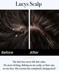 Celsiora® Seborrheic Dermatitis Relief Derm Serum