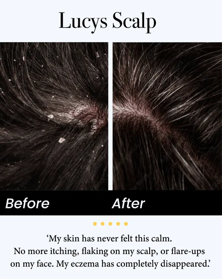 Celsiora® Seborrheic Dermatitis Relief Derm Serum