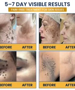 Celsiora® 7-Day MicroNeedle Skin Tag & Wart Removal Patch