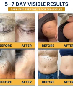 Celsiora® 7-Day MicroNeedle Skin Tag & Wart Removal Patch