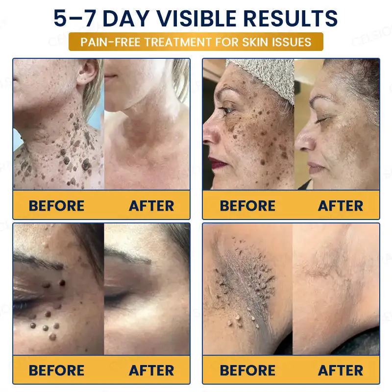 Celsiora® 7-Day MicroNeedle Wart & Skin Tag Removal Patch