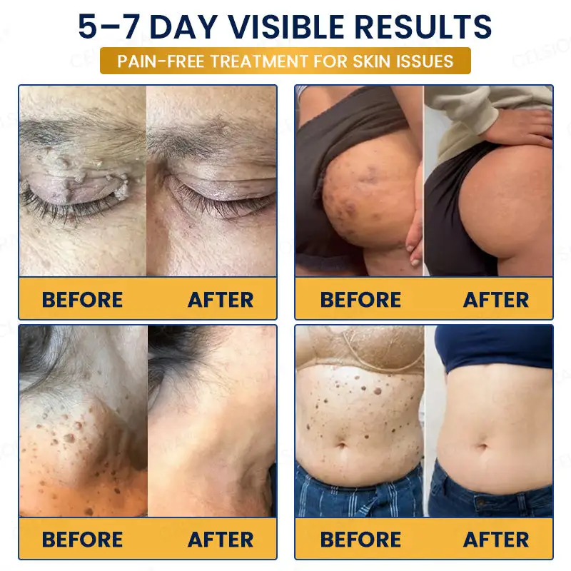 Celsiora® 7-Day MicroNeedle Wart & Skin Tag Removal Patch