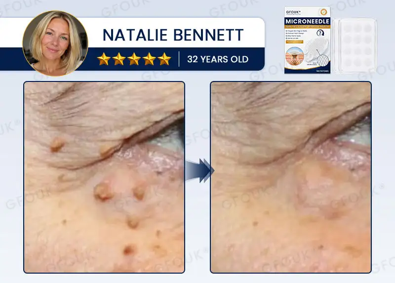 Celsiora® 7-Day MicroNeedle Wart & Skin Tag Removal Patch