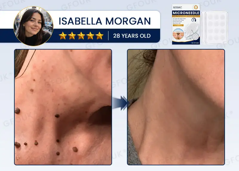 Celsiora® 7-Day MicroNeedle Wart & Skin Tag Removal Patch