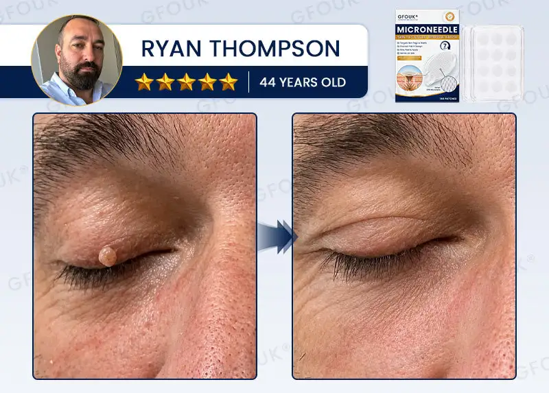 Celsiora® 7-Day MicroNeedle Wart & Skin Tag Removal Patch