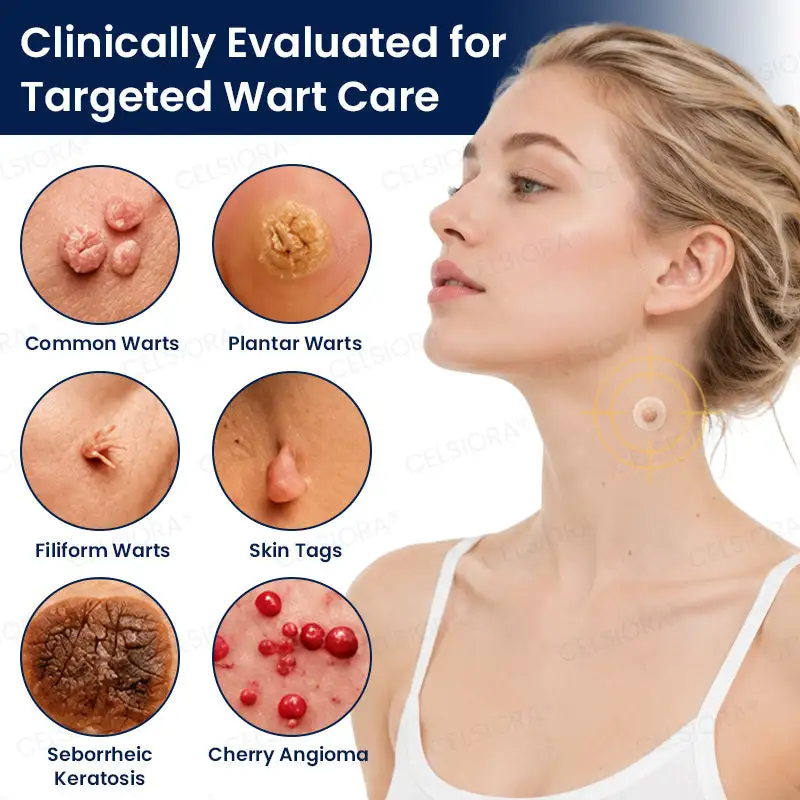 Celsiora® 7-Day MicroNeedle Wart & Skin Tag Removal Patch