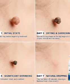 Celsiora® 7 Day Wart & Skin Tag Remover Foam