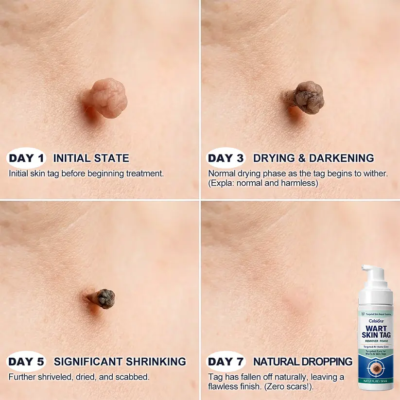 Celsiora® 7 Day Wart & Skin Tag Remover Foam